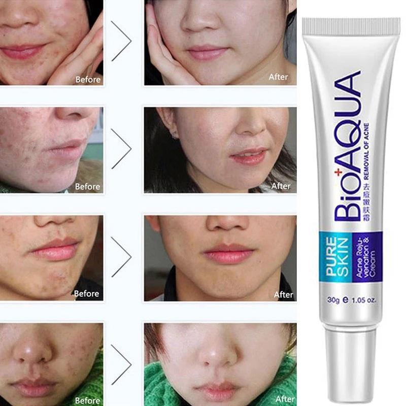 Acne Scar Removal Rejuvenation Cream, 30 Ml